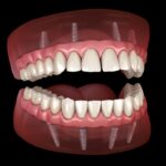 Implant supported dentures