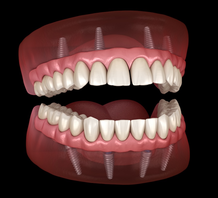 Implant supported dentures